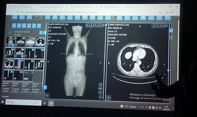 Dünyaya örnek oldu! Türkiye'de bir ilk: Kanser tedavisinde yapay zeka kullanıldı