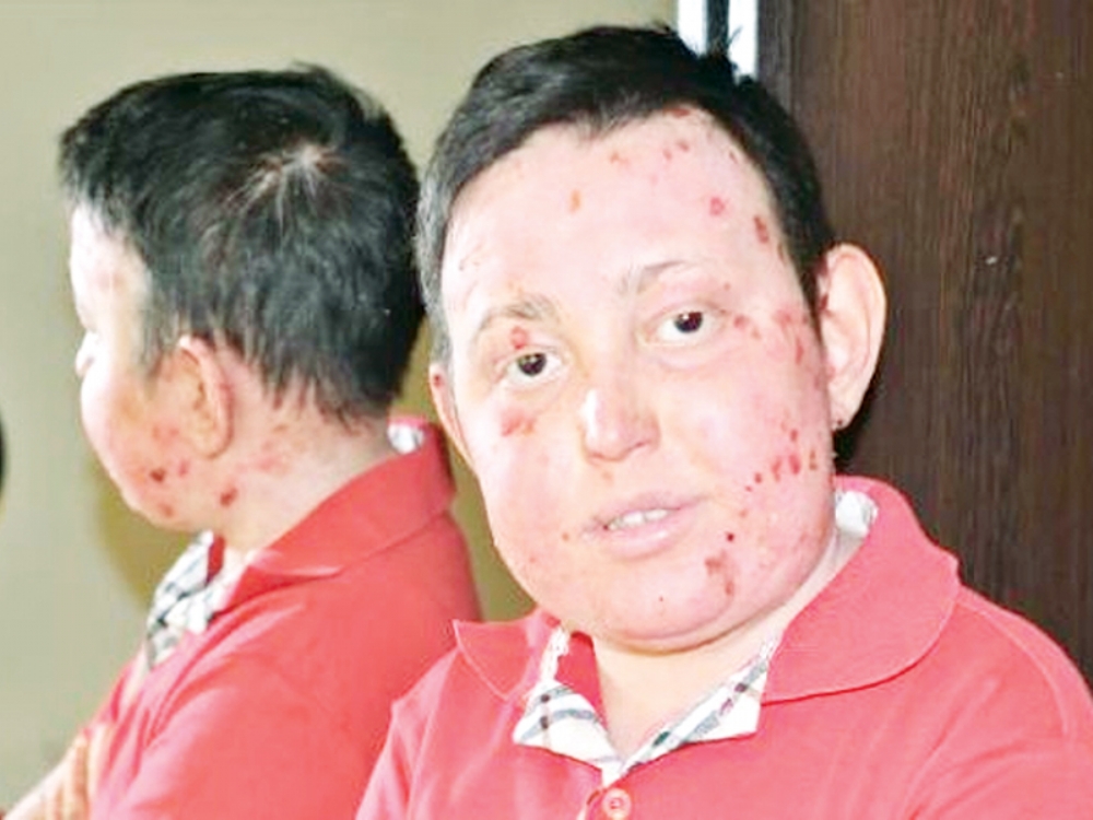 Emirhan, Kesin Tedavisi Olmayan Hastalıkla Mücadele Ediyor