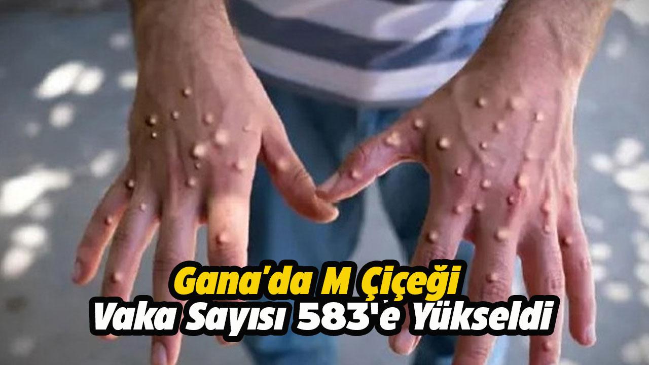 Gana'da M çiçeği vaka sayısı 583'e yükseldi