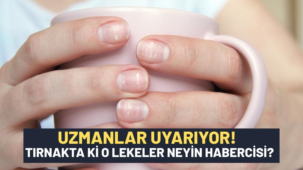 Lökonişi nedir? Tırnakta beyaz lekelerin görünmeyen nedenleri