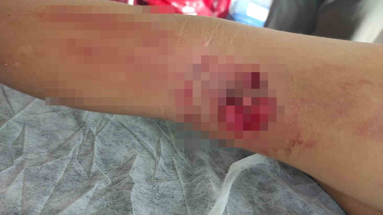 Okula giderken sokak köpeğinin saldırısına uğradı