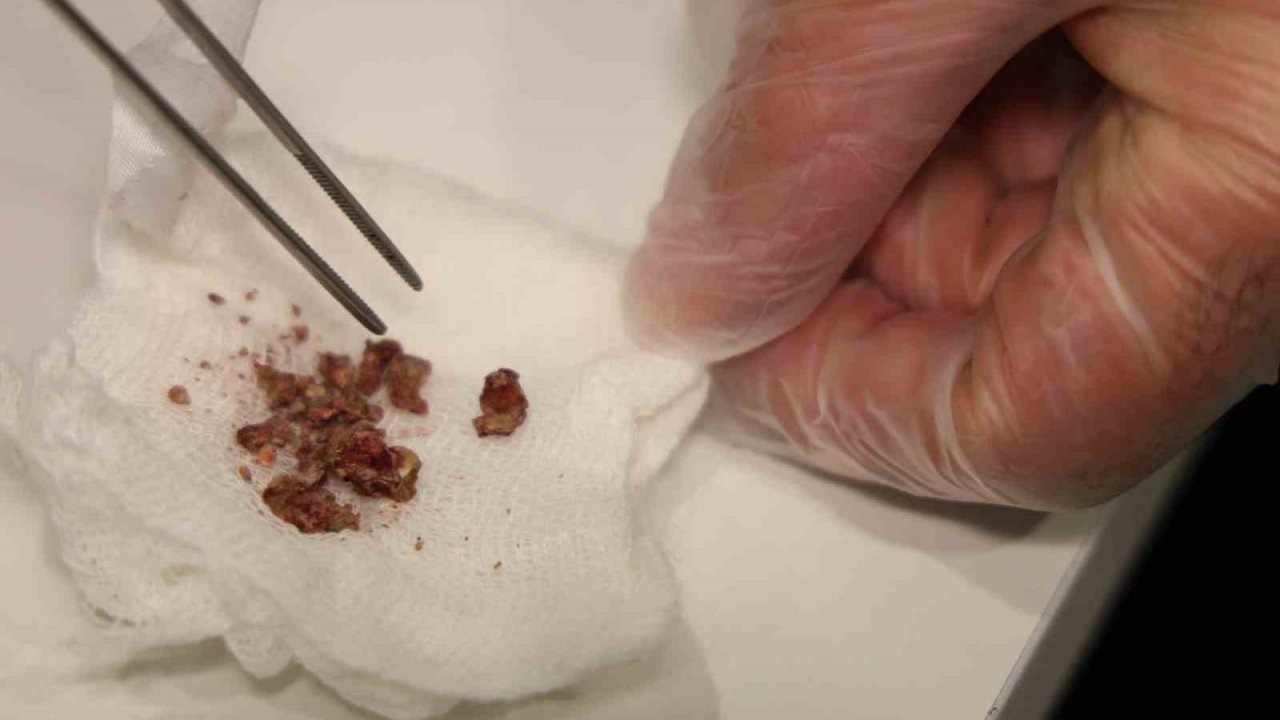 Estetik ameliyatta şaşırtan olay, burundan taş çıktı