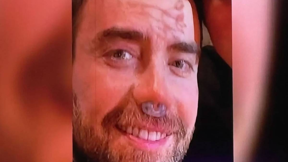 Murat Dalkılıç, burnu için 12. kez ameliyat masasına yattı