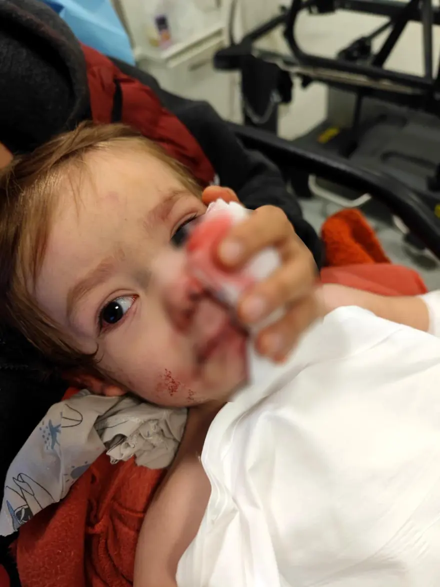 Minik Efe'nin yüzündeki ısırık izleri kalıcı olacak