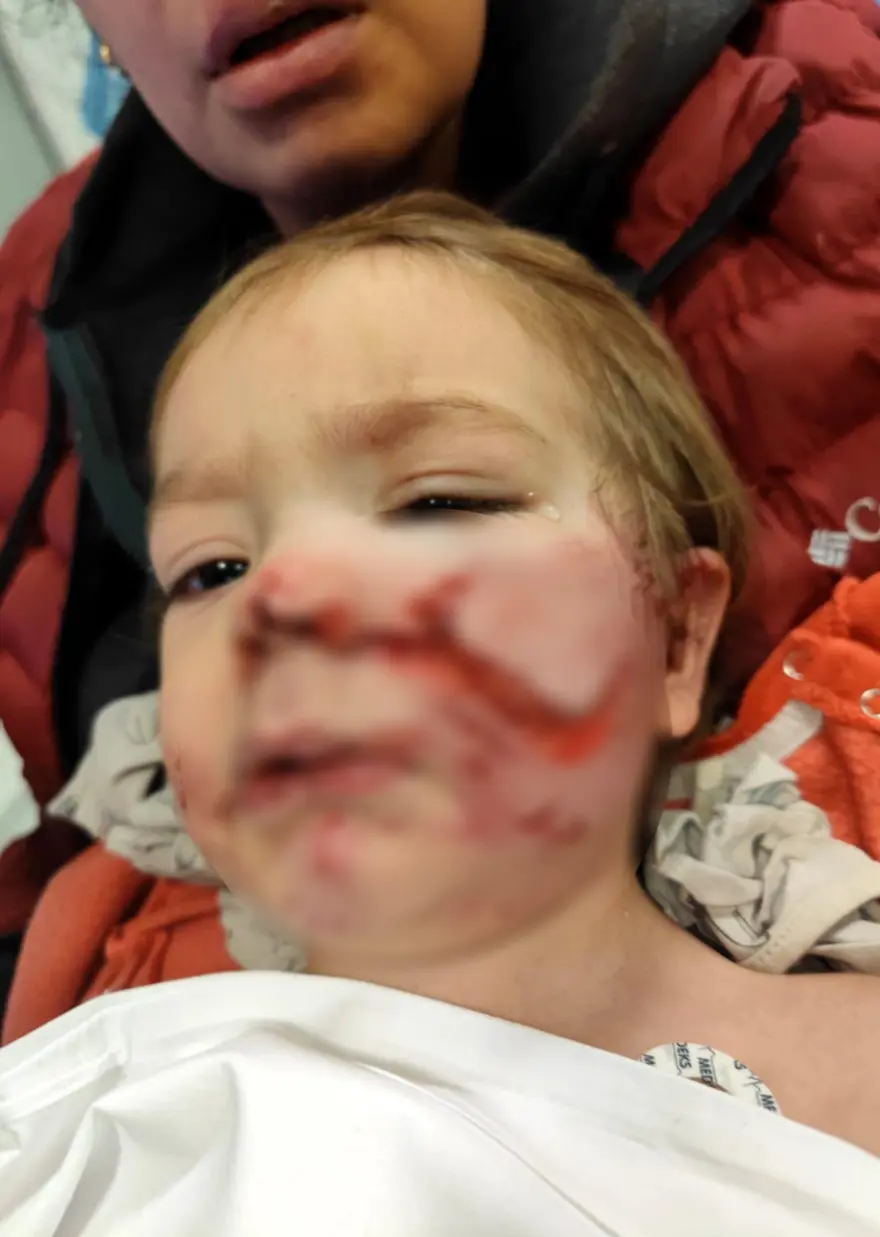 Minik Efe'nin yüzündeki ısırık izleri kalıcı olacak