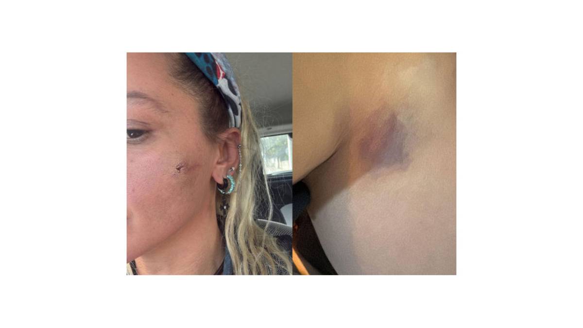 Yıldız Asyalı eşi tarafından darp mı edildi? Mustafa Semih Demirci'den açıklama